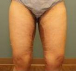 MEDIAL THIGH LIFT: Case 63 After